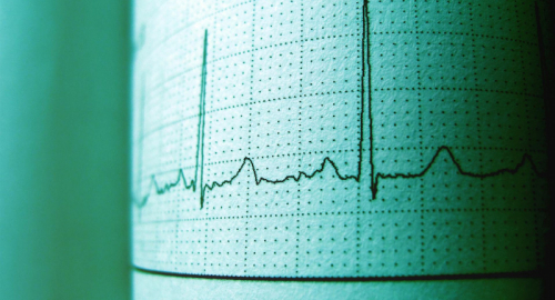 Gli SGLT2 Inibitori: Una Nuova Frontiera nella Cura dello Scompenso Cardiaco con Frazione di Eiezione Preservata